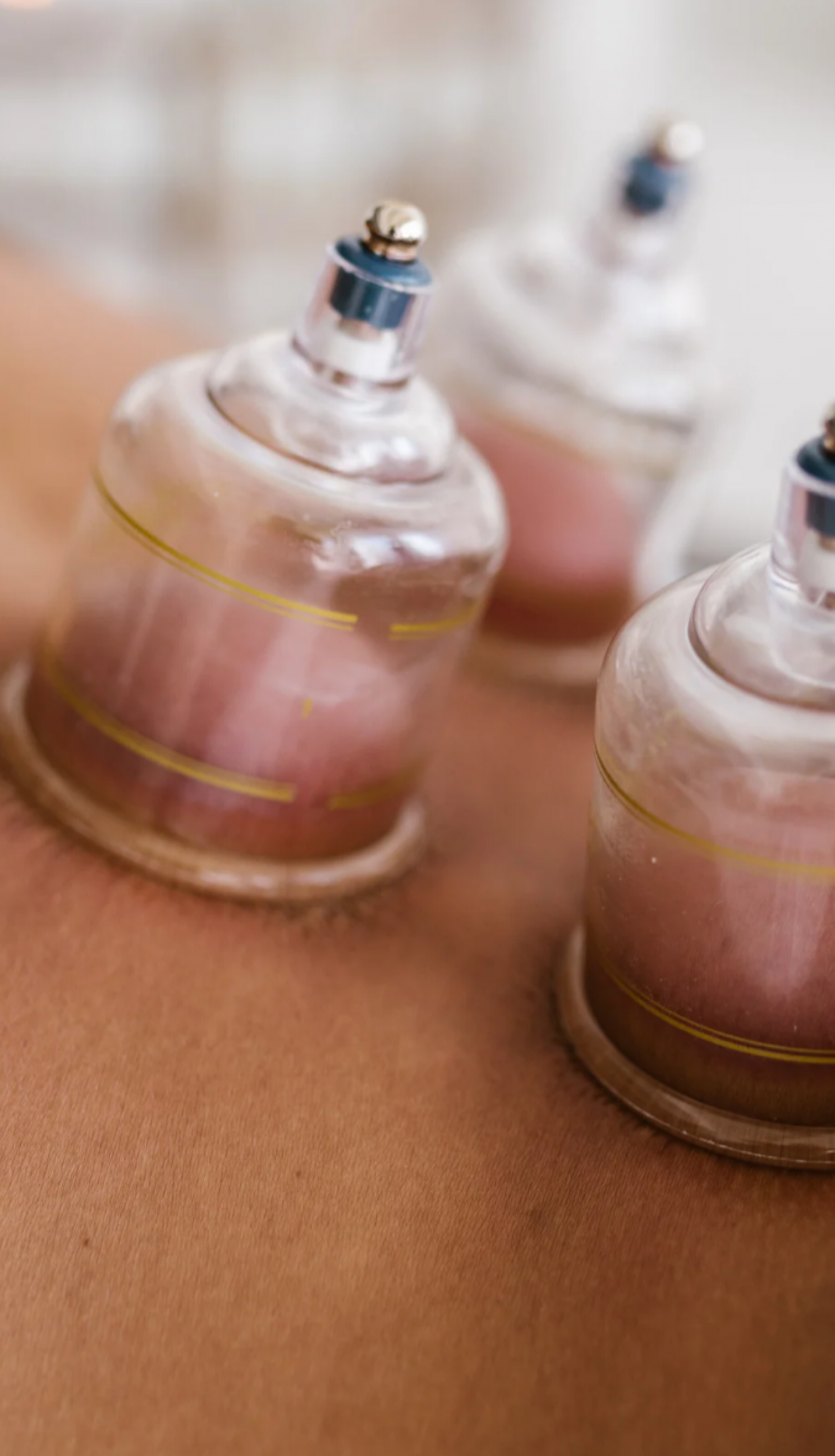 Nassschröpfen als naturheilkundliche Therapie bei e n d e r û n in Stuttgart